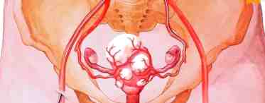 Женские болезни: Кистома левого яичника