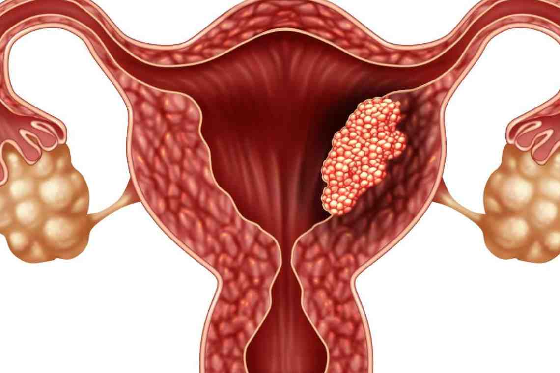 Эндометриозная киста яичника