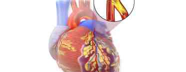 Лечение инфаркта миокарда