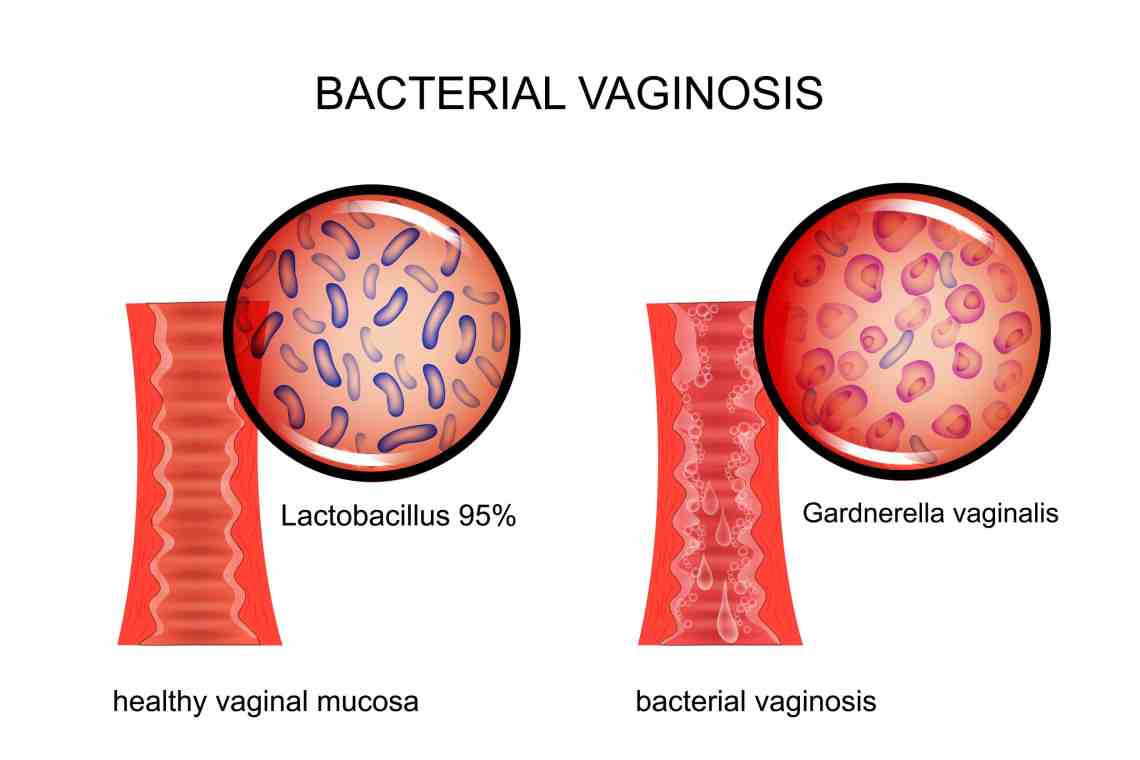 Gardnerella vag – симптомы и лечение