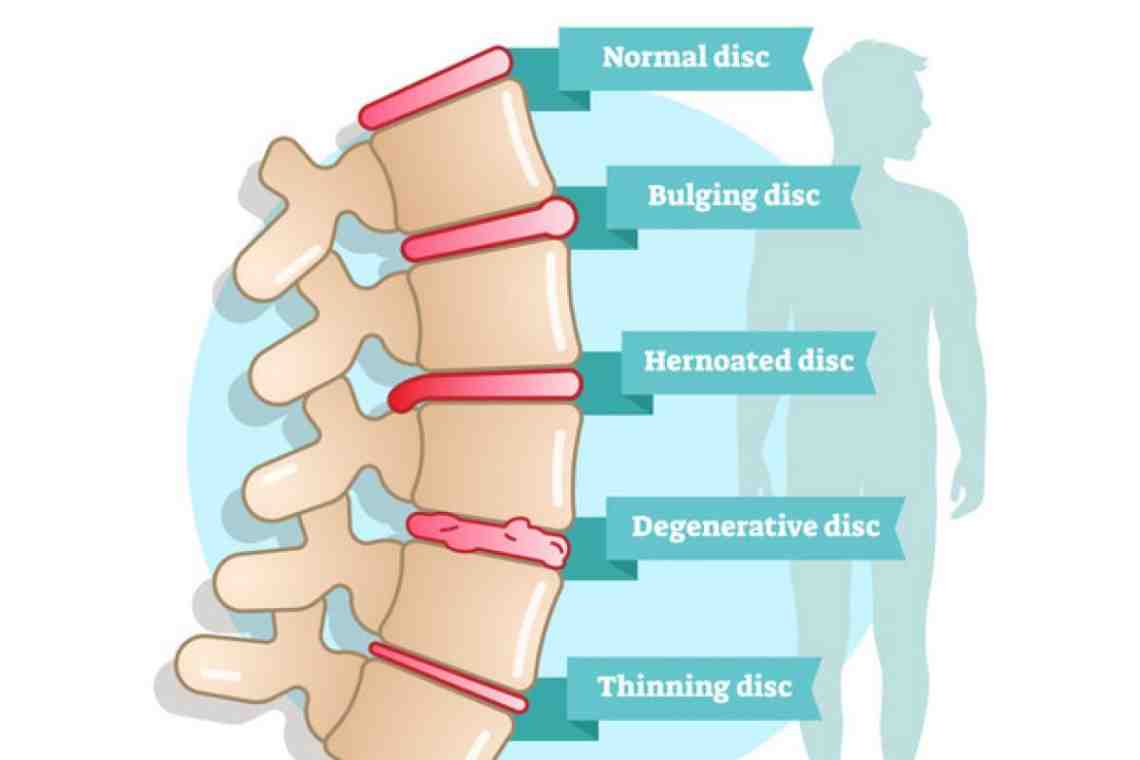 Стадии остеохондроза позвоночника картинки