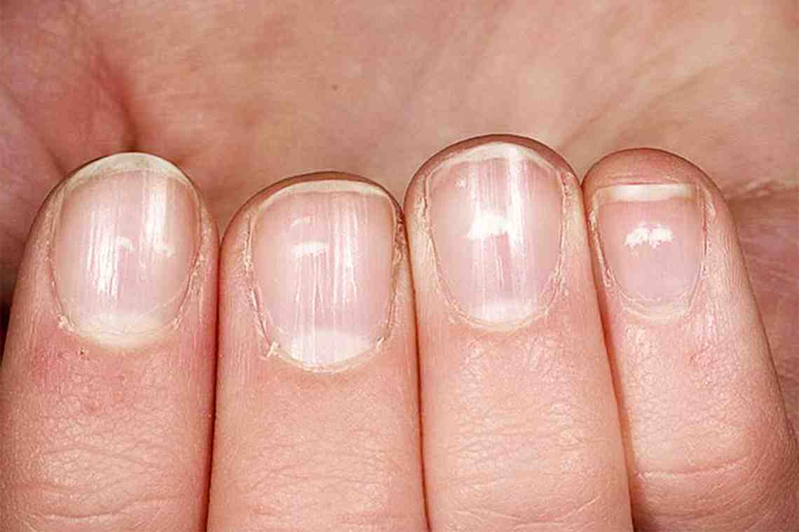Грибок на ногтях рук: описание болезни и лечение
