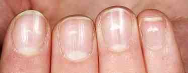Грибок на ногтях рук: описание болезни и лечение