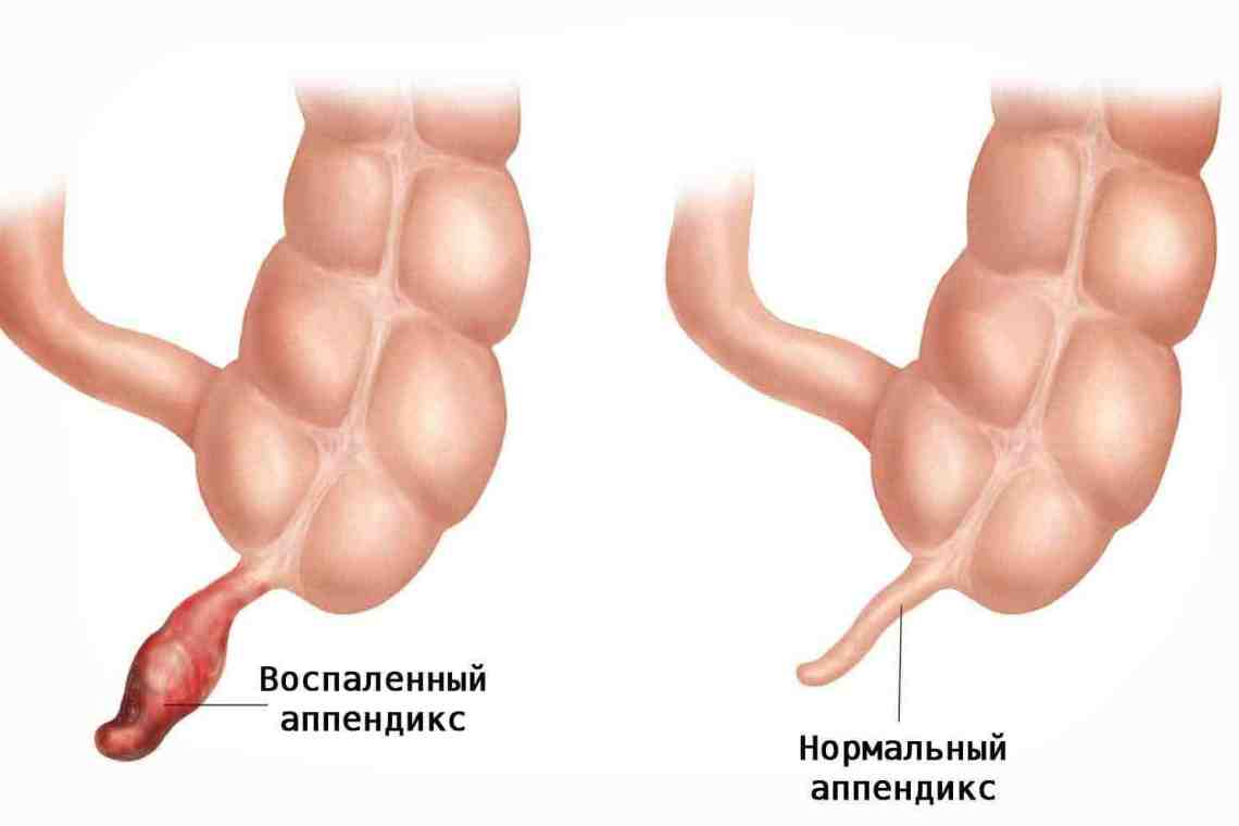 Как определить аппендицит в домашних условиях? Несколько полезных советов