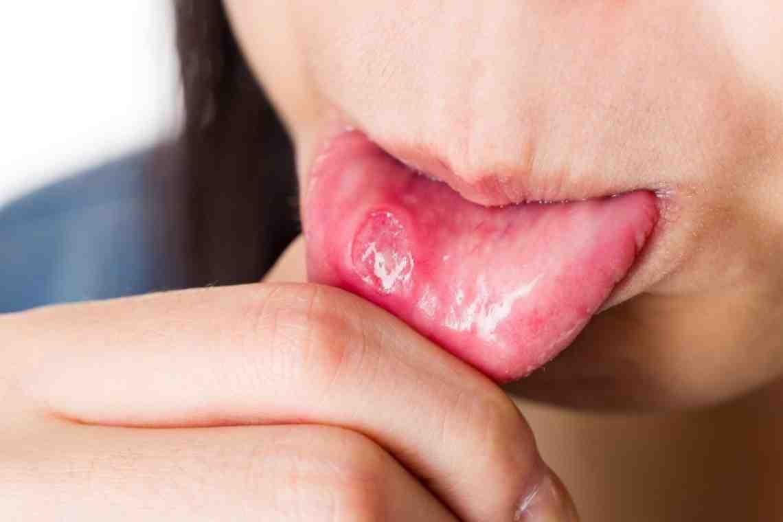 Какие бывают болячки во рту?