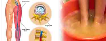 Защемление нерва в пояснице: лечение и симптомы