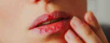 Почему трескаются уголки губ?