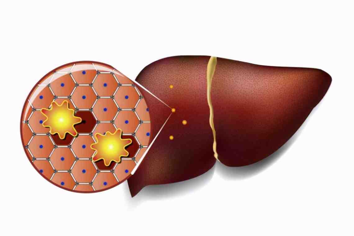 Жировой гепатоз печени: причины, симптомы, диагностика и лечение