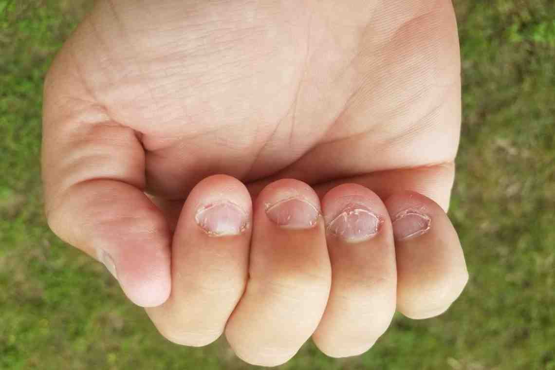 Как прекратить грызть ногти