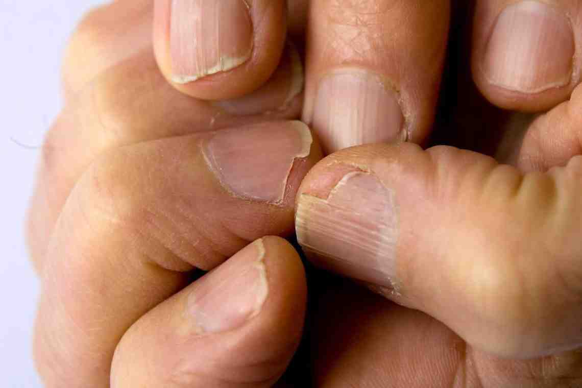 Что на самом деле такое грибковая инфекция ногтей?
