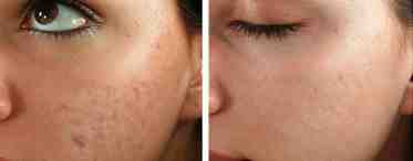 Как избавиться от рубцов на коже с помощью косметологических процедур