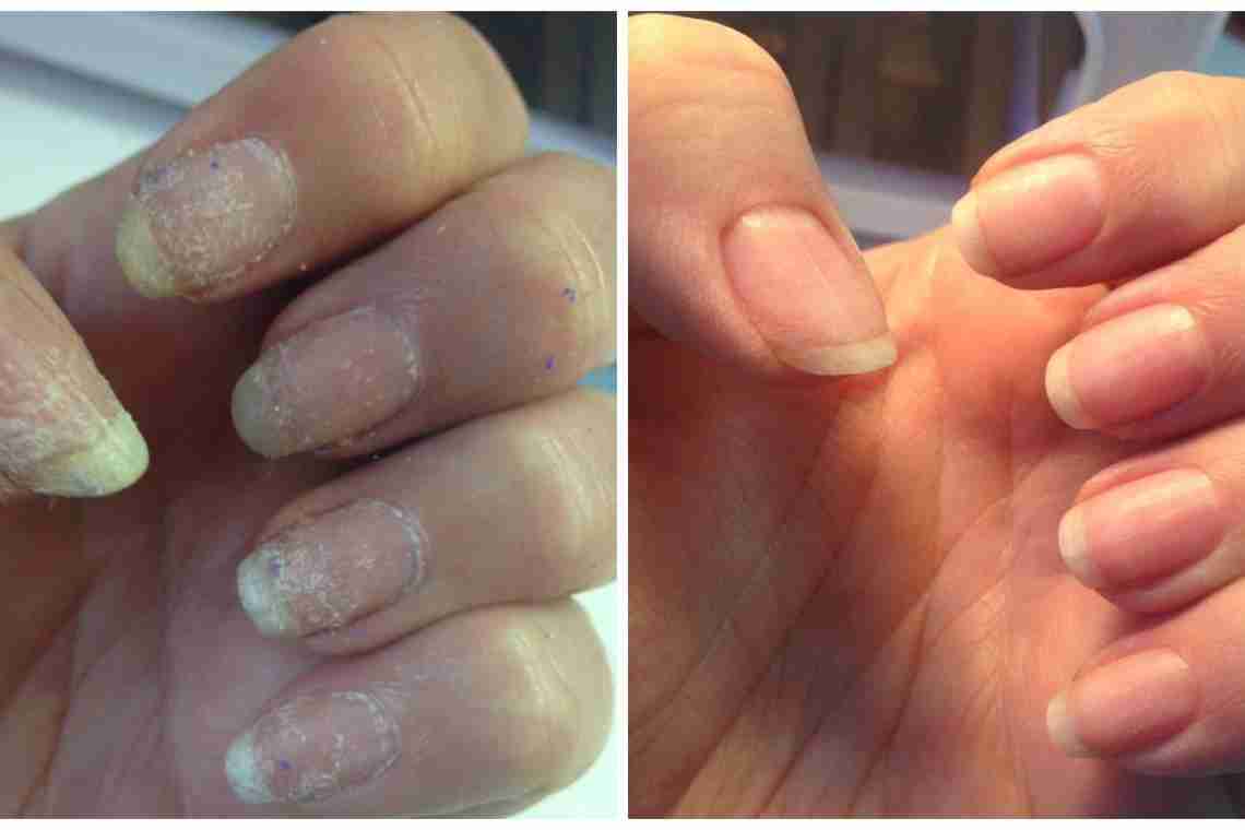 Последствия после наращивания ногтей