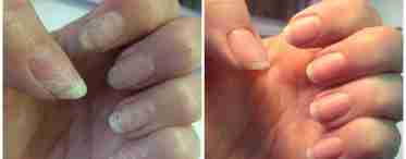 Последствия после наращивания ногтей