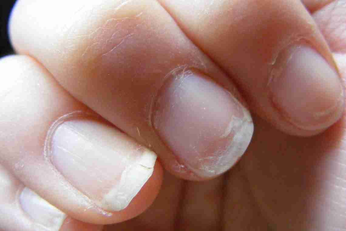 Как укрепить хрупкие и ломкие ногти