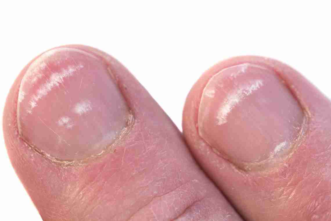 Причины заболевания ногтей