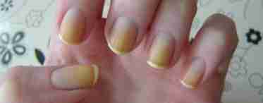 Методы лечения и причины желтых ногтей