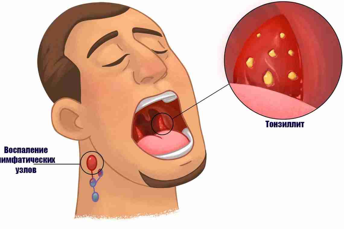 Хронический тонзиллит: симптомы и лечение