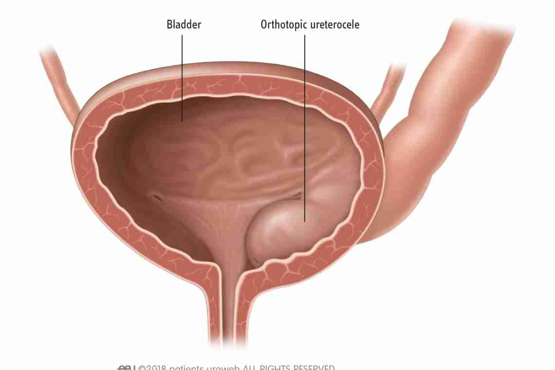 Мочевой пузырь ощущение. Уретероцеле мочевого пузыря. Уретероцеле цистоскопия. Ортотопическое уретероцеле. Уретероцеле мочеточника кт.