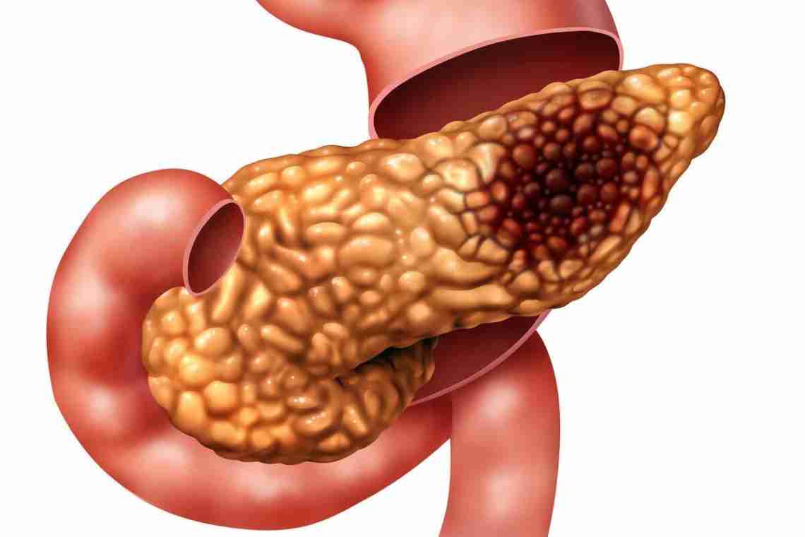 Панкреонекроз поджелудочной железы – симптомы и лечение