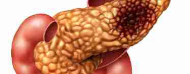 Панкреонекроз поджелудочной железы – симптомы и лечение