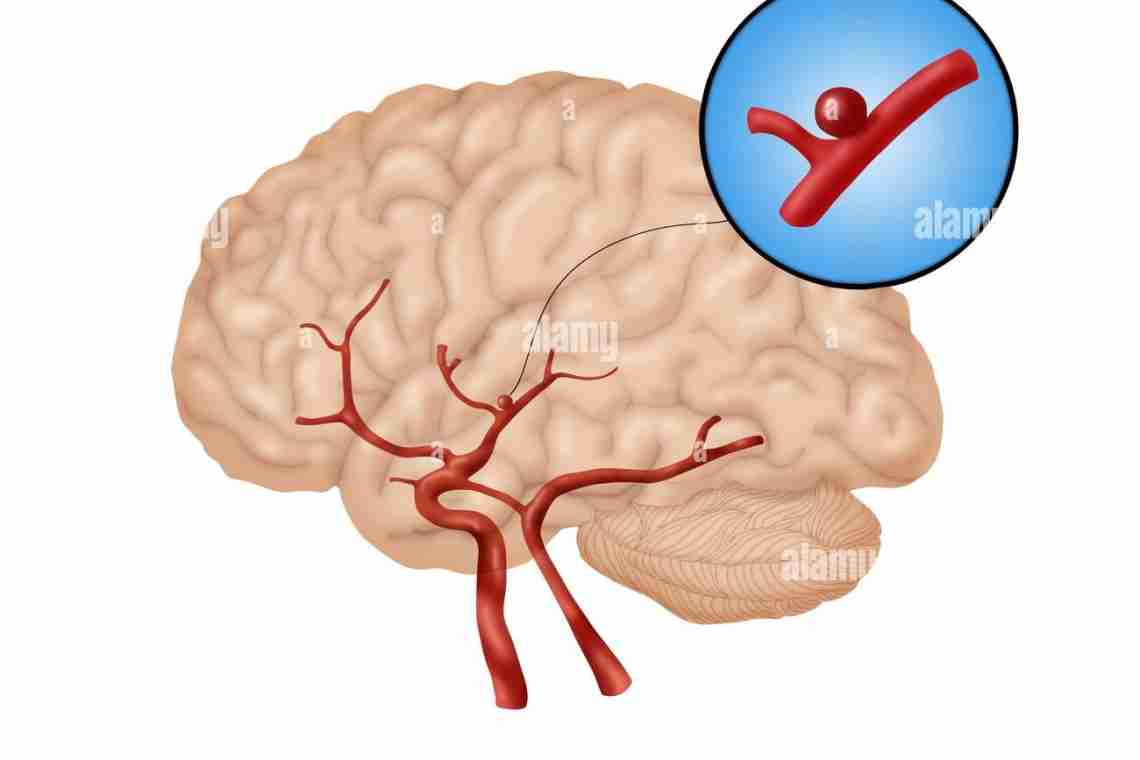 Ишемия сосудов головного мозга: причины, симптомы и особенности лечения