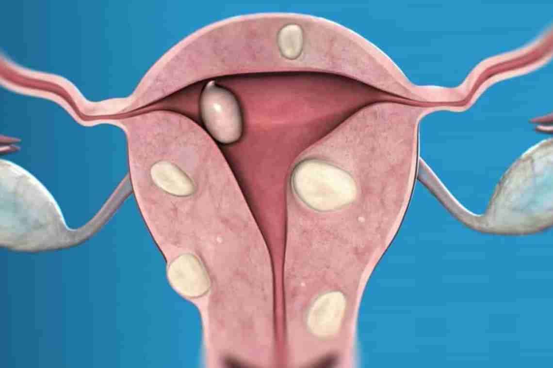 Фиброматоз матки: понятие, диагностика, лечение.