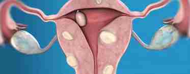 Фиброматоз матки: понятие, диагностика, лечение.