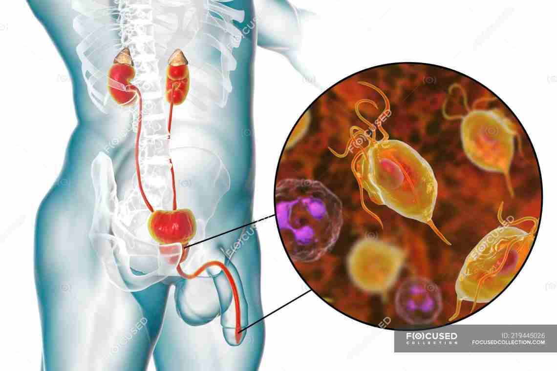 Трихомонада: симптомы
