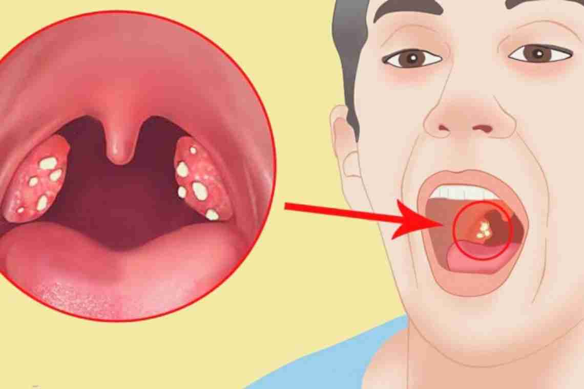Неприятный привкус ацетона во рту - сигнал болезни