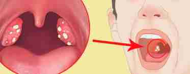 Неприятный привкус ацетона во рту - сигнал болезни