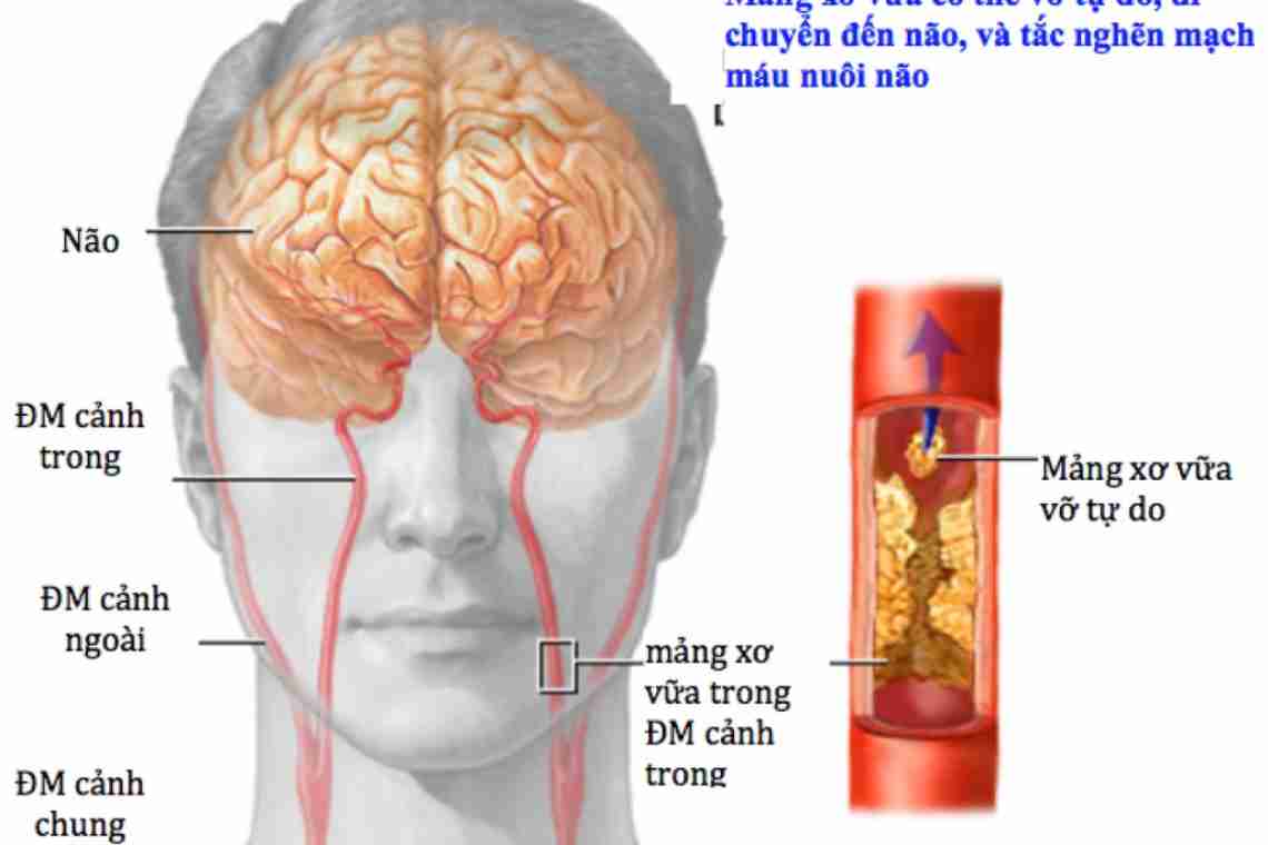 Сужение сосудов головного мозга: симптомы и способы лечения
