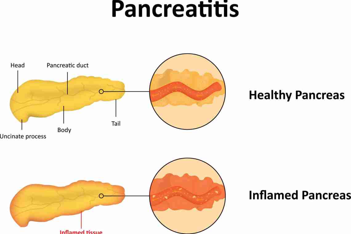 Панкреатит: симптомы, лечение и виды заболевания