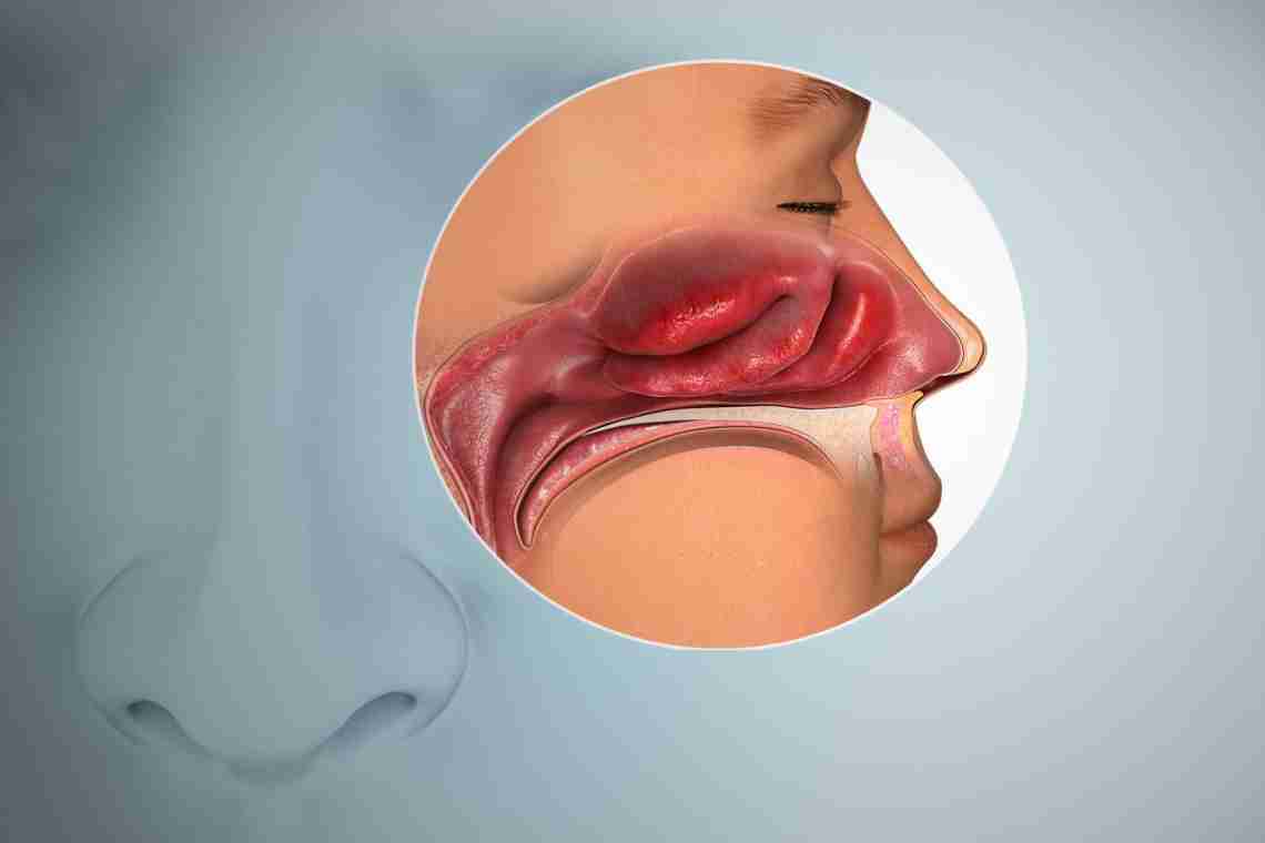 Заложенность Носа Без Насморка: Лечение Возможно