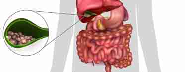 Хронический холецистит - лечение и симптоматика заболевания