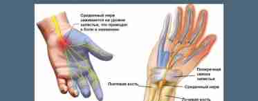Симптомы защемления нерва и причины возникновения.