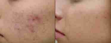 Подкожный клещ на лице: симптомы и способы лечения