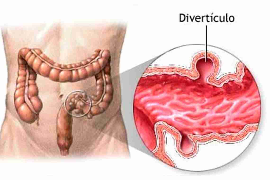 Дивертикулез сигмовидной кишки: симптомы, причины и особенности лечения
