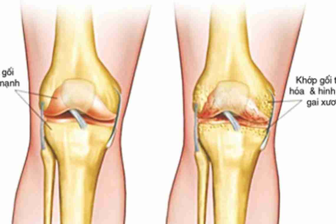Жидкость в коленном суставе: лечение и симптомы.