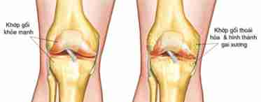 Жидкость в коленном суставе: лечение и симптомы.