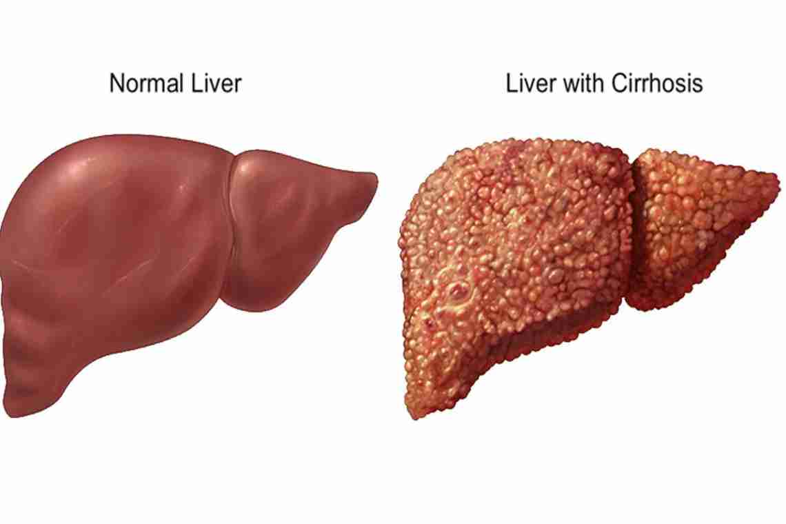 Гепатит в переходит в цирроз. Здоровая печень и цирроз.