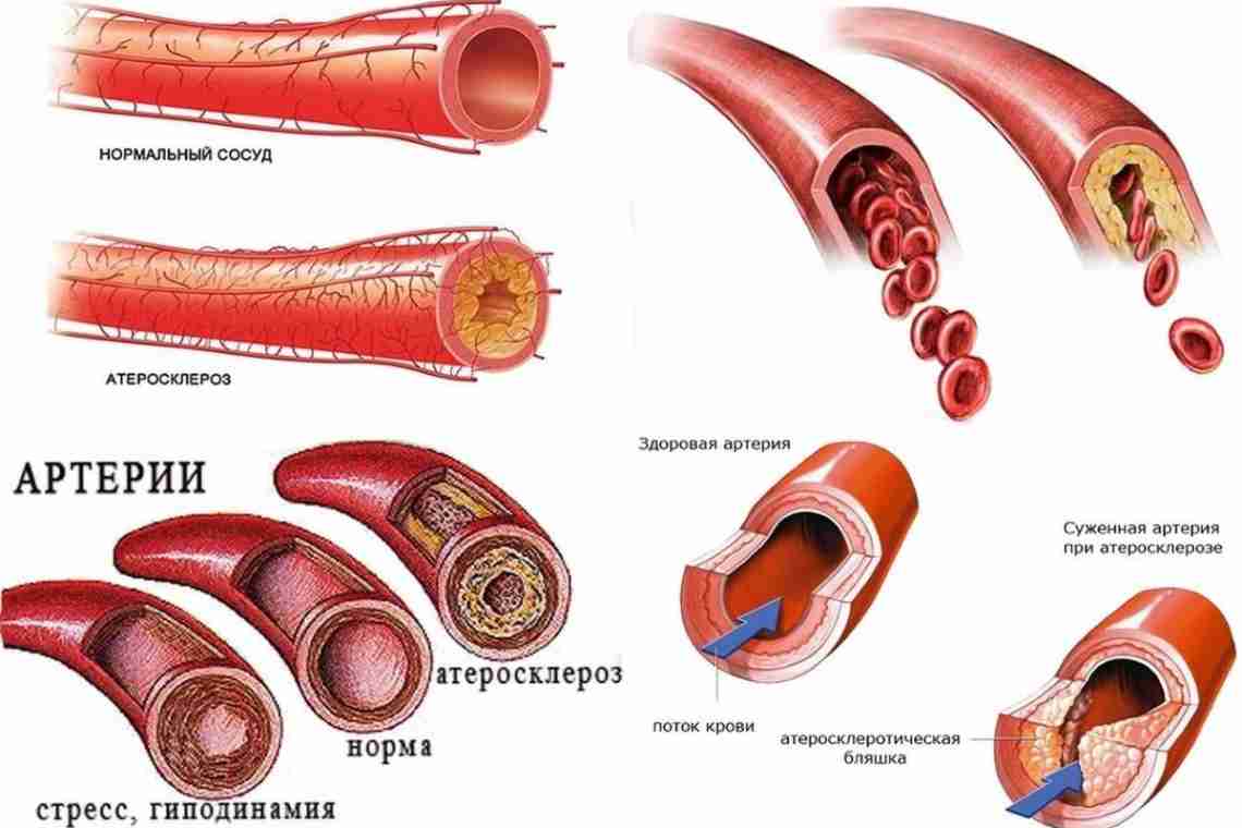 Атерсклероз коронарных сосудов, аорты, сосудов нижних конечностей, почечных артерий, атеросклероз сосудов головного мозга - симптомы, лечение и профил