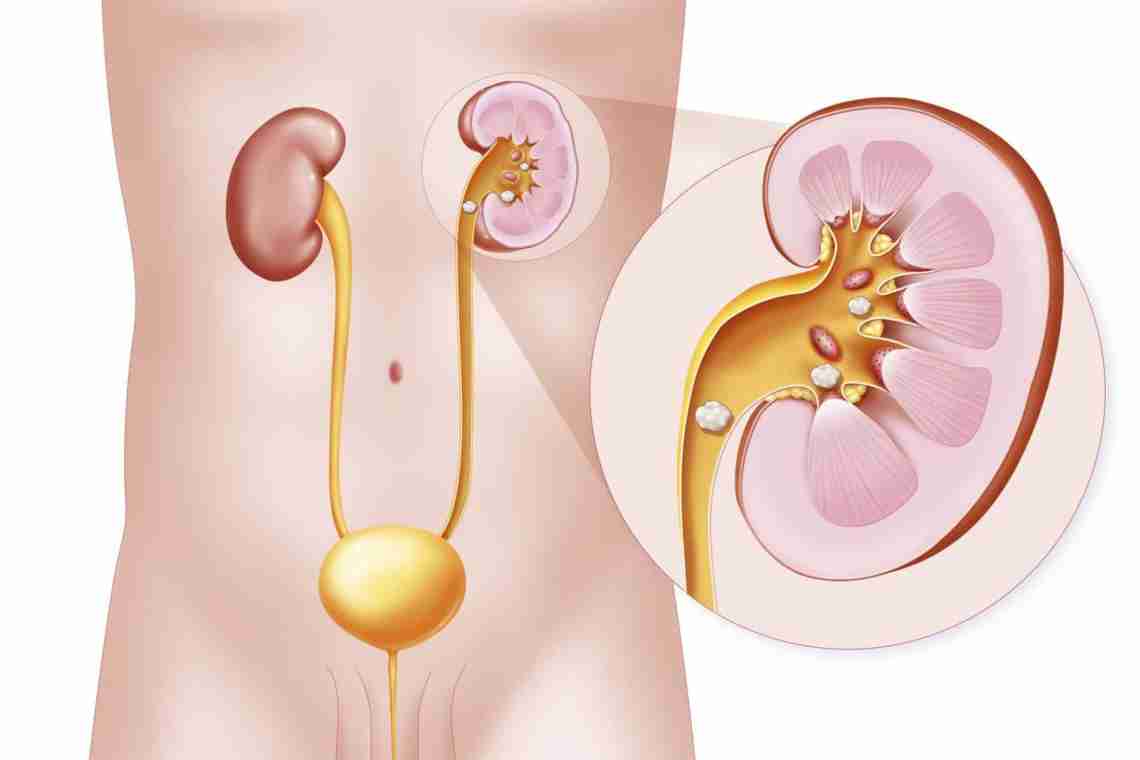 Камни в мочевом пузыре: симптомы и лечение