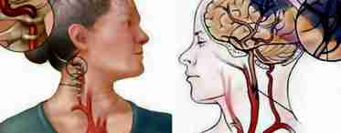 Спазм сосудов головного мозга: симптомы, лечение и последствия