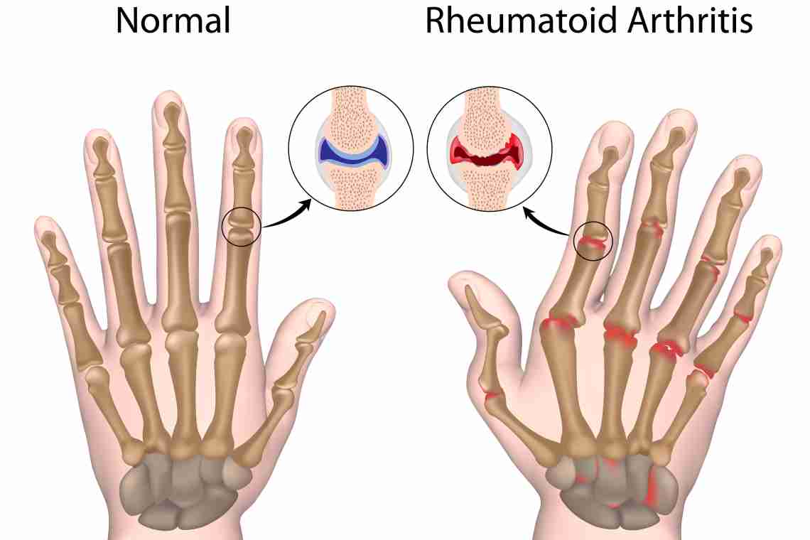 Если у вас ревматоидный артрит, лечение должно быть комплексным