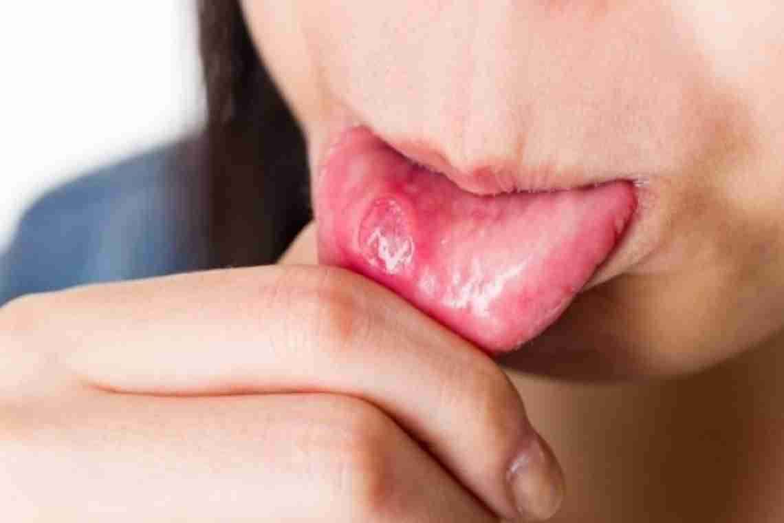 Рекомендации и советы, как лечить стоматит во рту