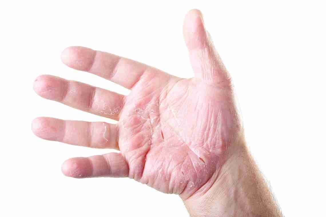 Дерматит на руках: симптомы, диагностика и способы лечения