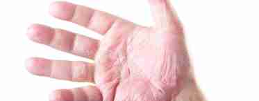 Дерматит на руках: симптомы, диагностика и способы лечения