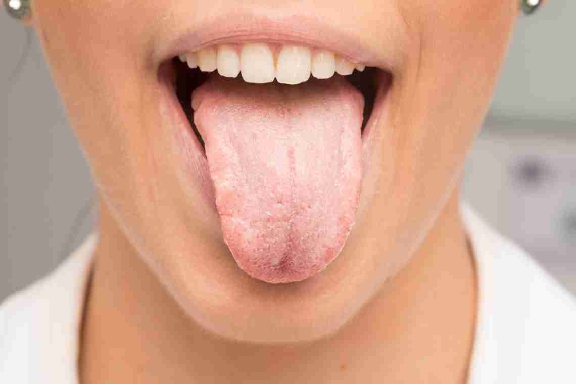 Лейкоплакия полости рта: симптомы и лечение