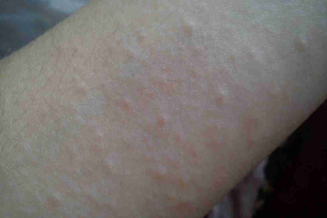 Сыпь на теле у взрослого – болезнь кожи или симптом другого заболевания