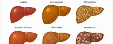 Воспаление печени: симптомы гепатита и цирроза.